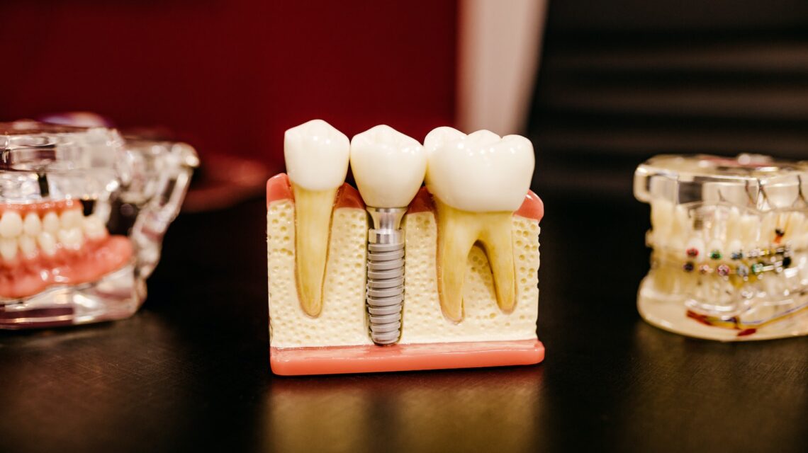 Dental Implants Troy