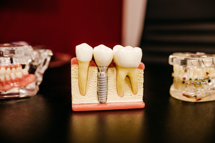 Dental Implants Troy