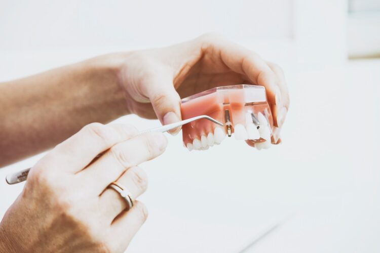 Dental implants in troy mi